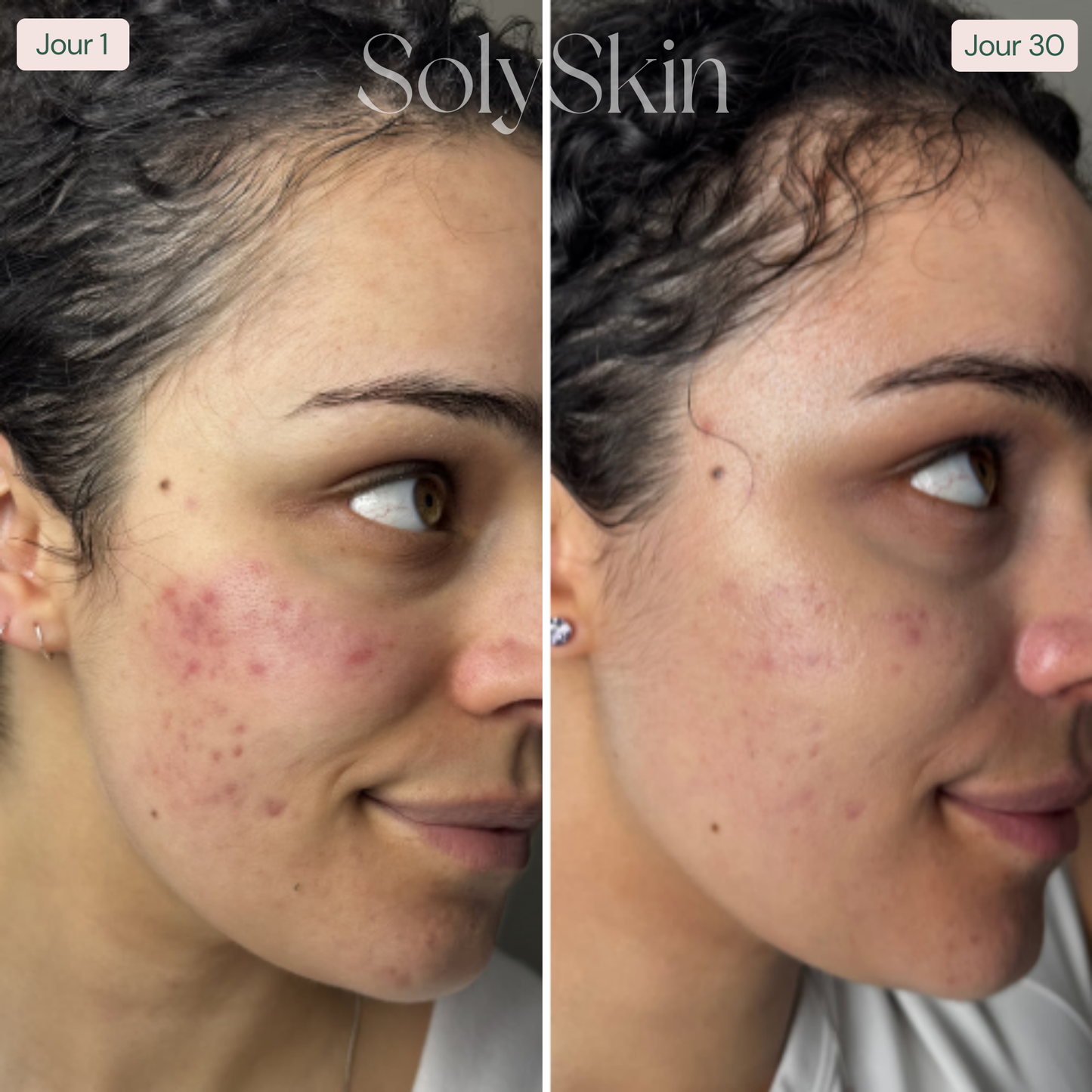 Soin LED Anti-Imperfections