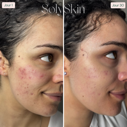 Soin LED Anti-Imperfections